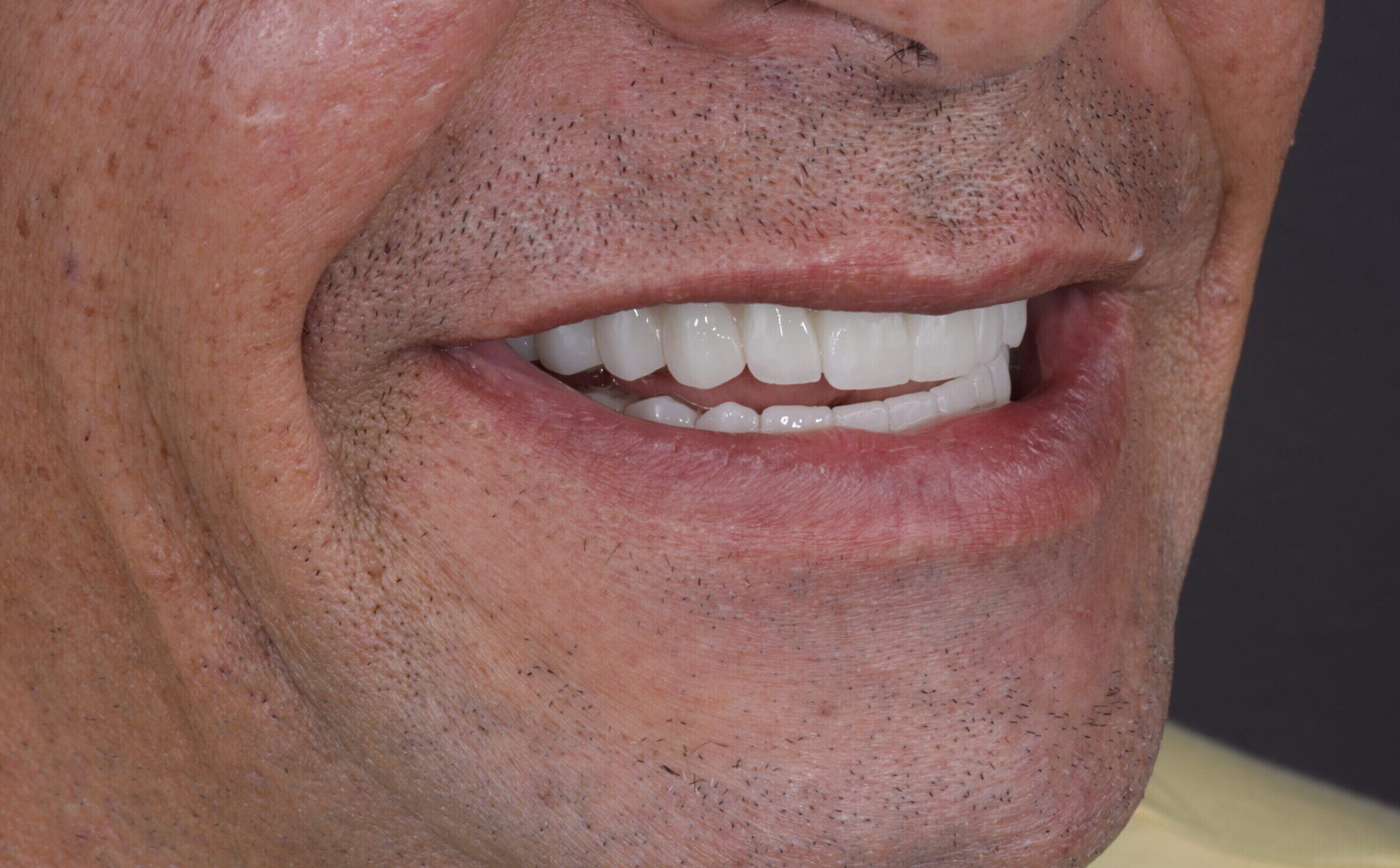 Porcelain Veneers for Dental Gaps and Crooked Teeth.