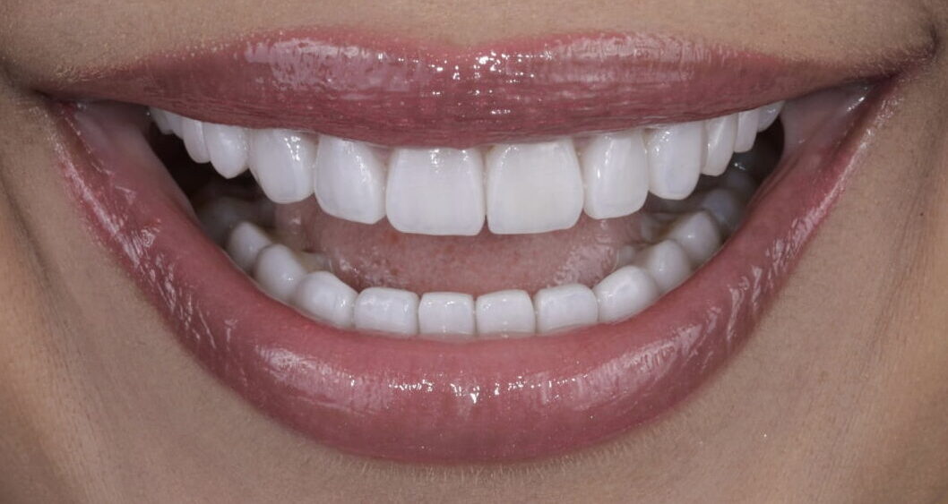 From Worn and Dull to Wow: Full Ceramic Veneers Makeover.