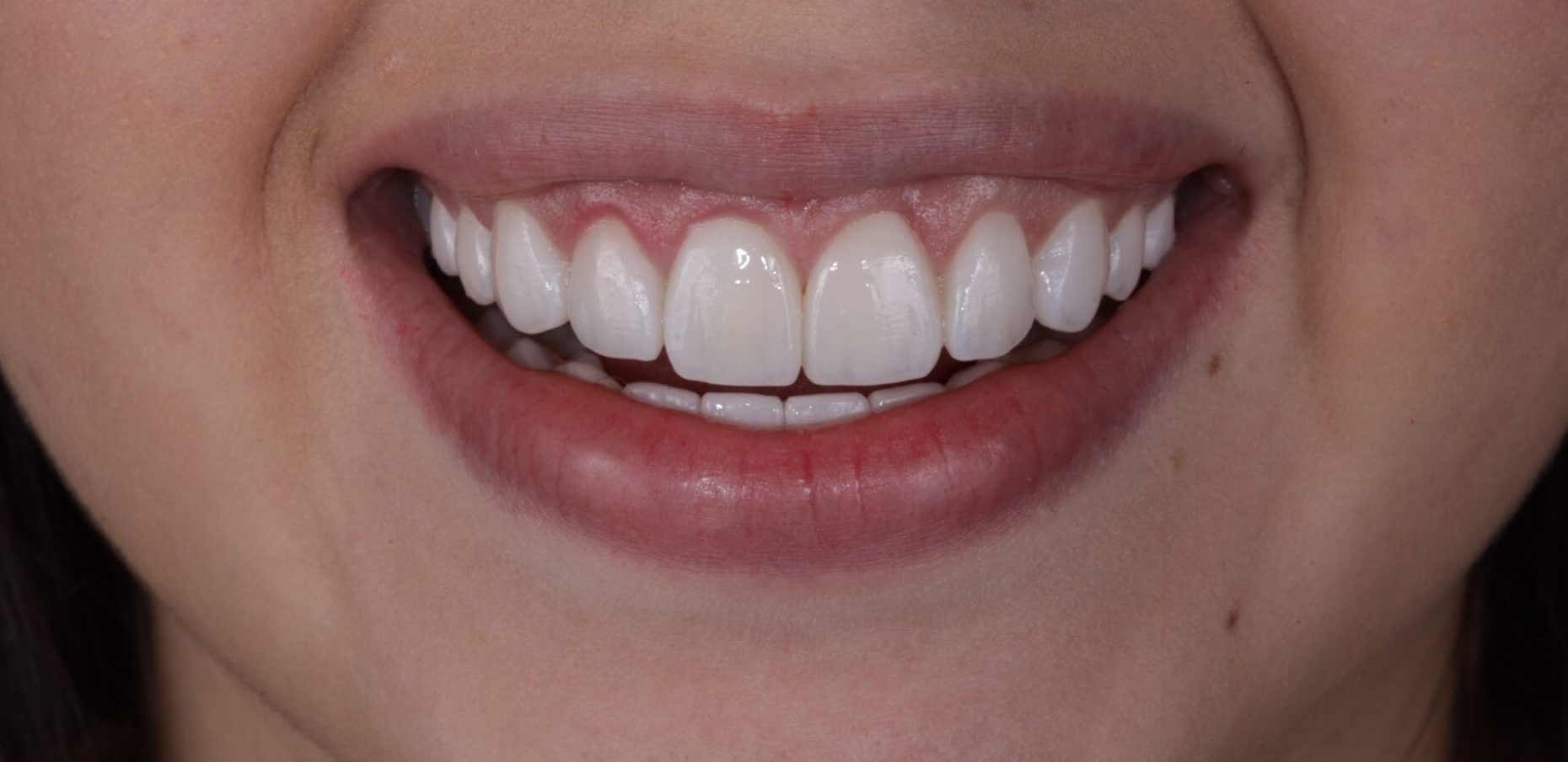 Unveiling Confidence: Yaileth’s Gummy Smile Solution.