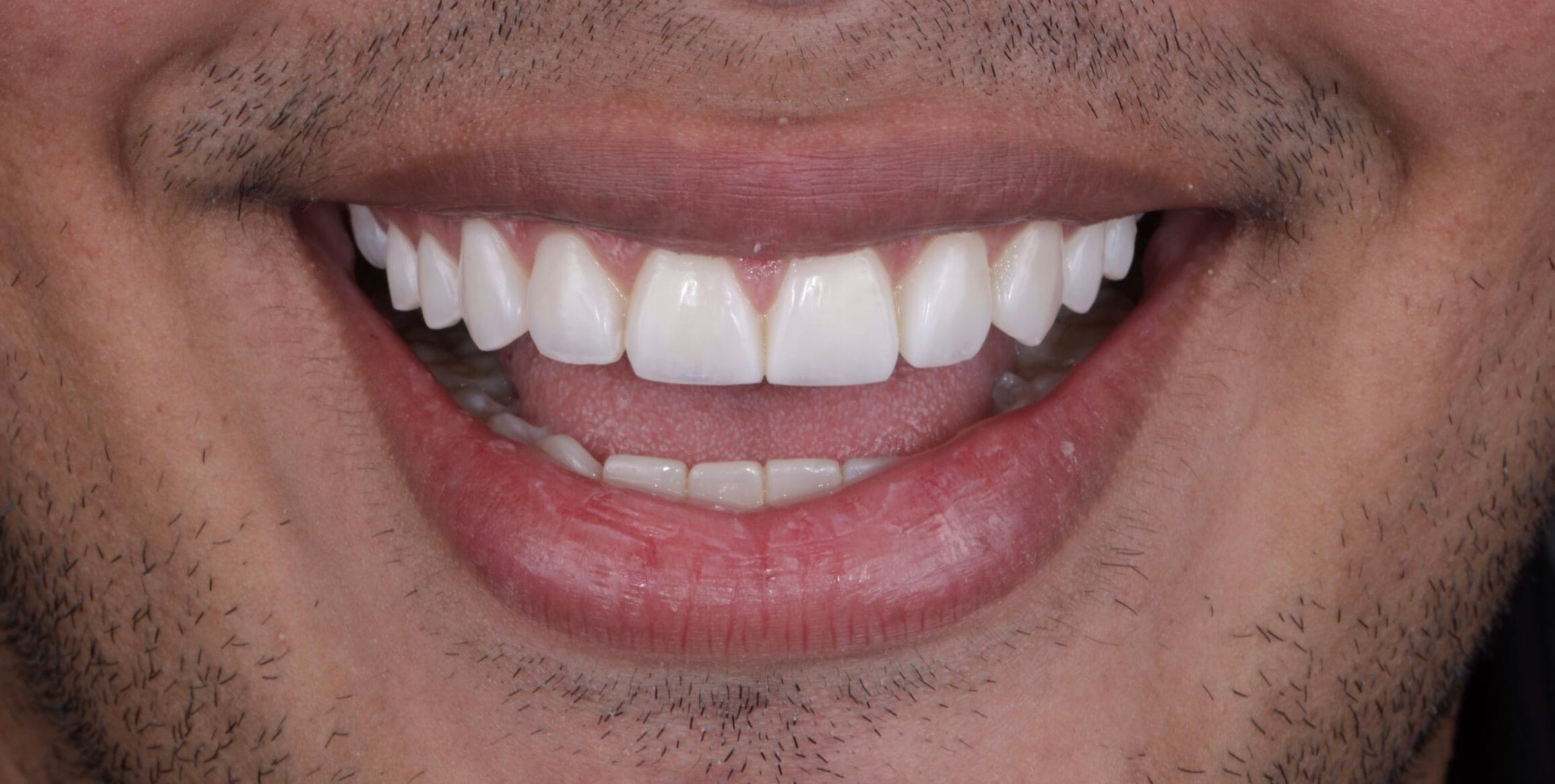 Closed Gaps. Aligned Smile.