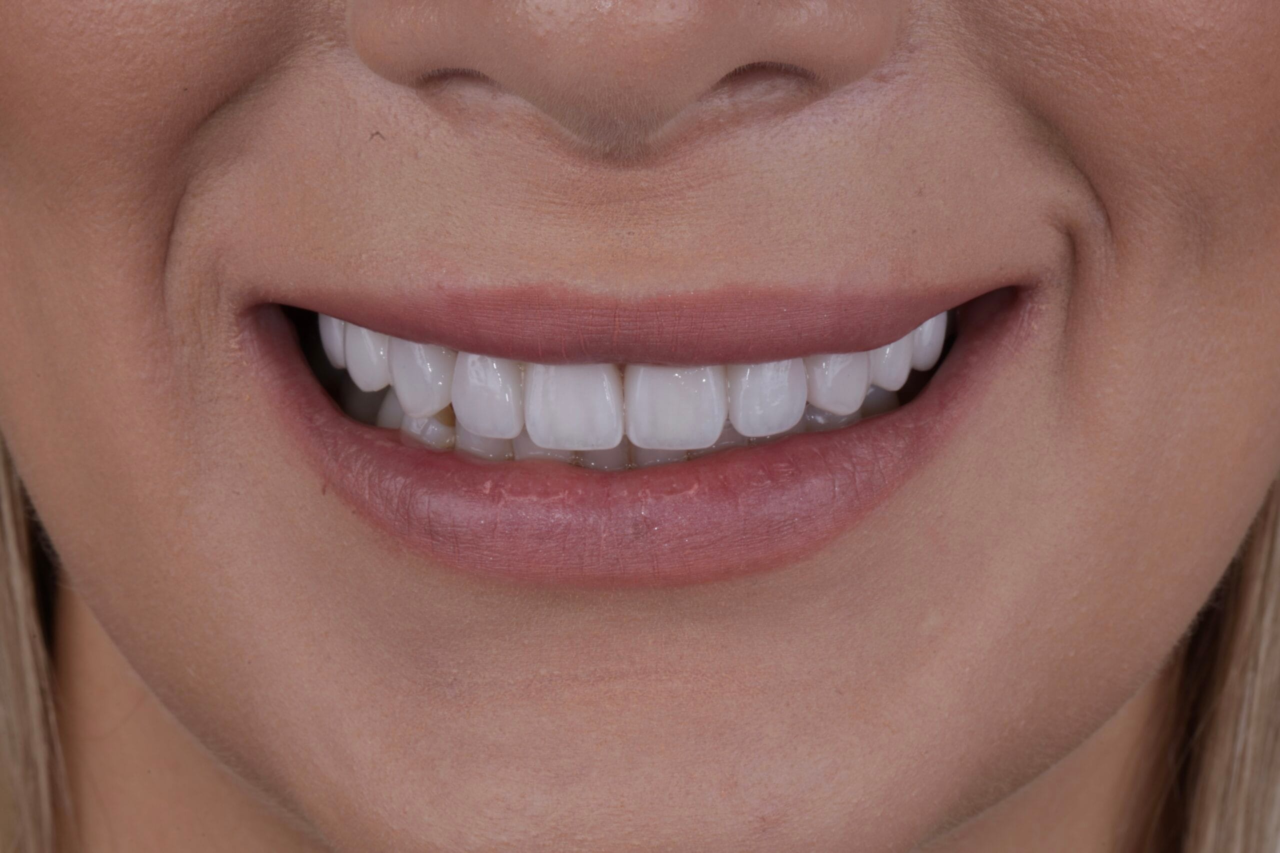 Redesigning the Smile: Gaps Closed, Teeth Aligned.