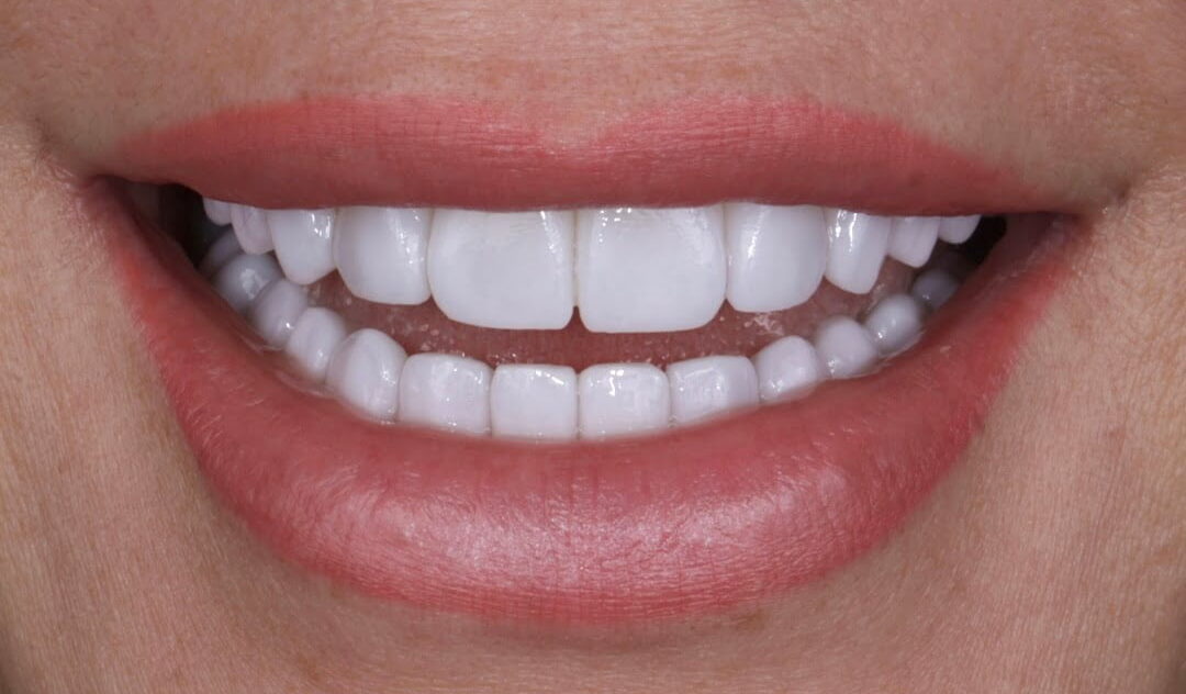 Case Review: Composite to Porcelain Veneers