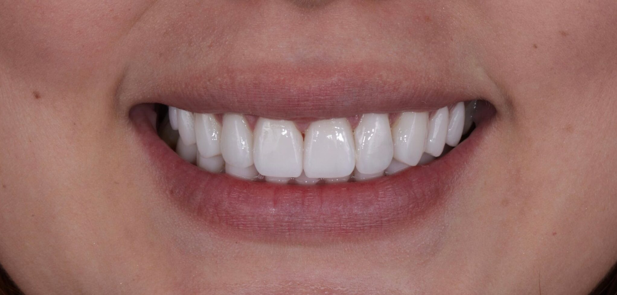 When Whitening Isn’t Enough