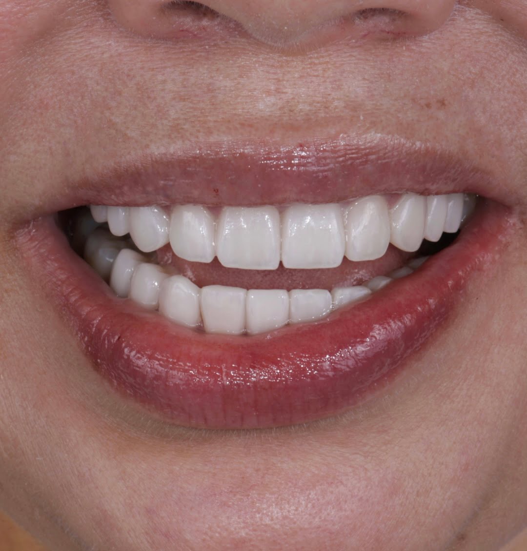 CASE REVIEW: OLD COMPOSITES TO PORCELAIN VENEERS