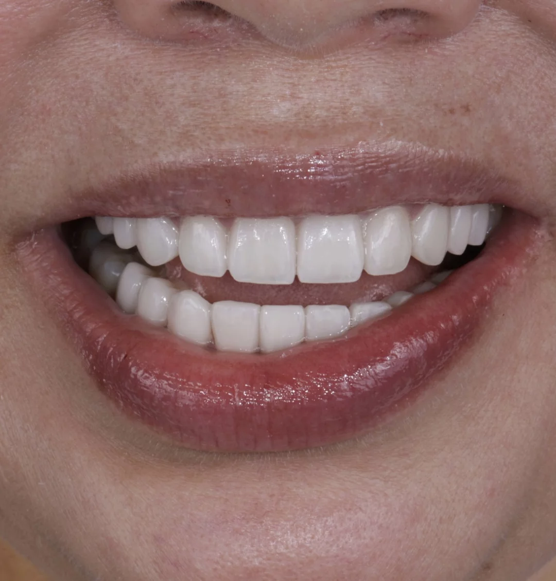 CASE REVIEW: OLD COMPOSITES TO PORCELAIN VENEERS