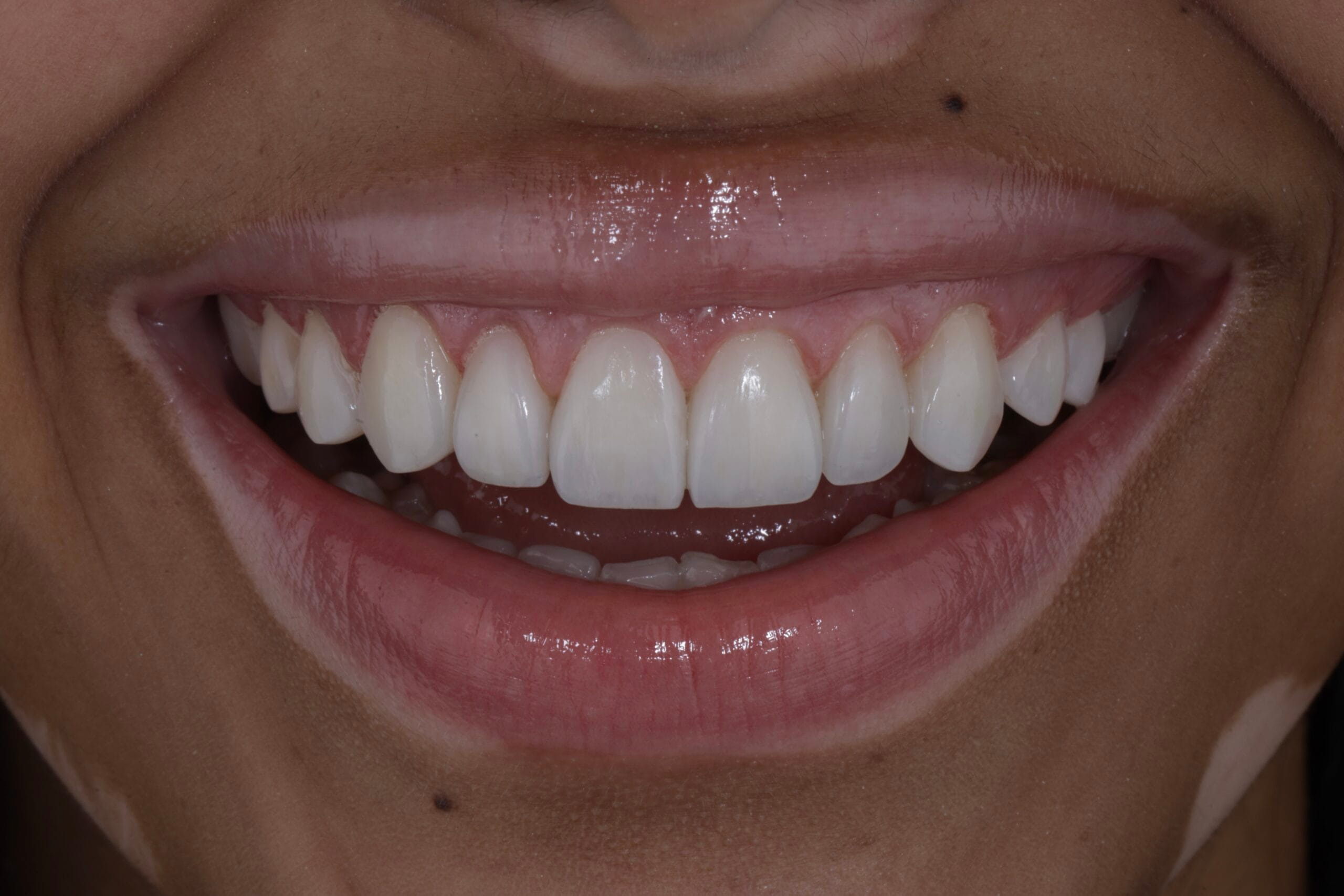 From Conical Teeth to a Radiant Smile: Fredelin’s Transformation