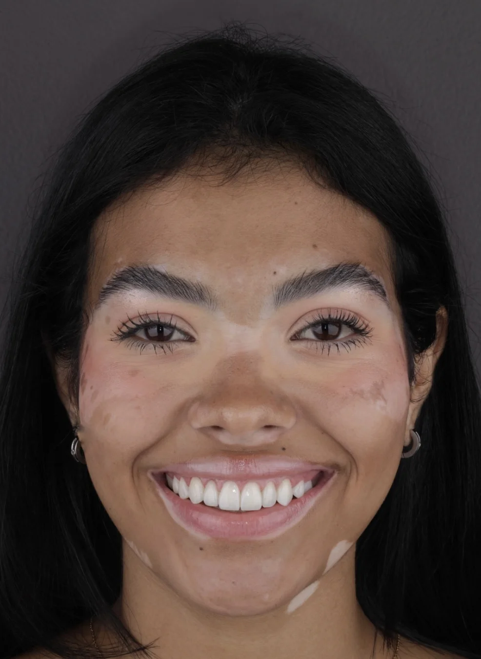 From Conical Teeth to a Radiant Smile: Fredelin’s Transformation
