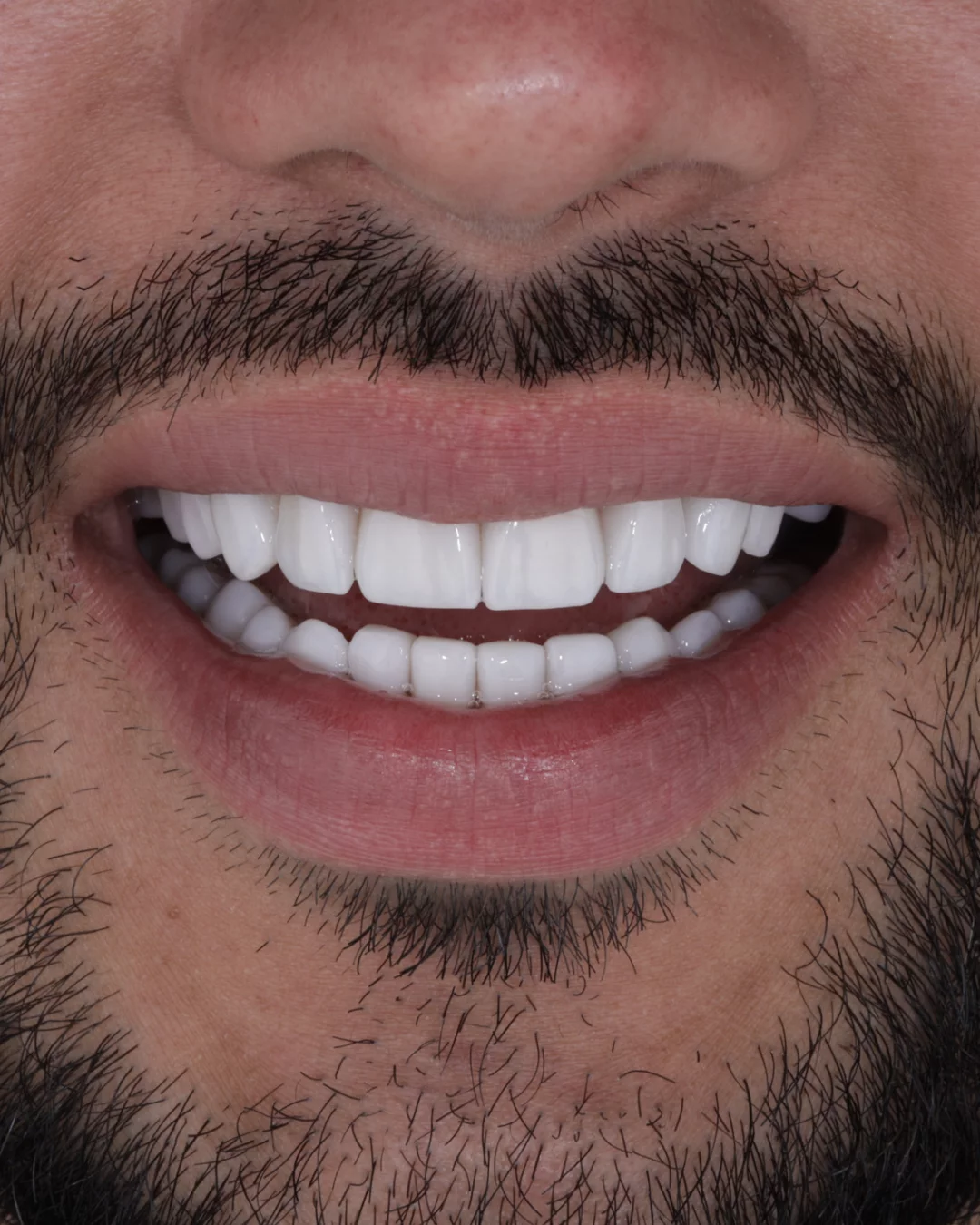 CASE REVIEW: MISALIGNED TEETH TO PORCELAIN VENEERS