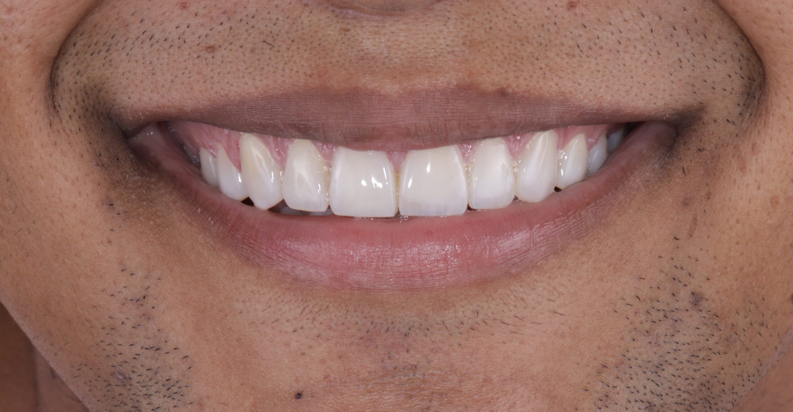 Indirect composite veneers to close dental gaps after orthodontics.