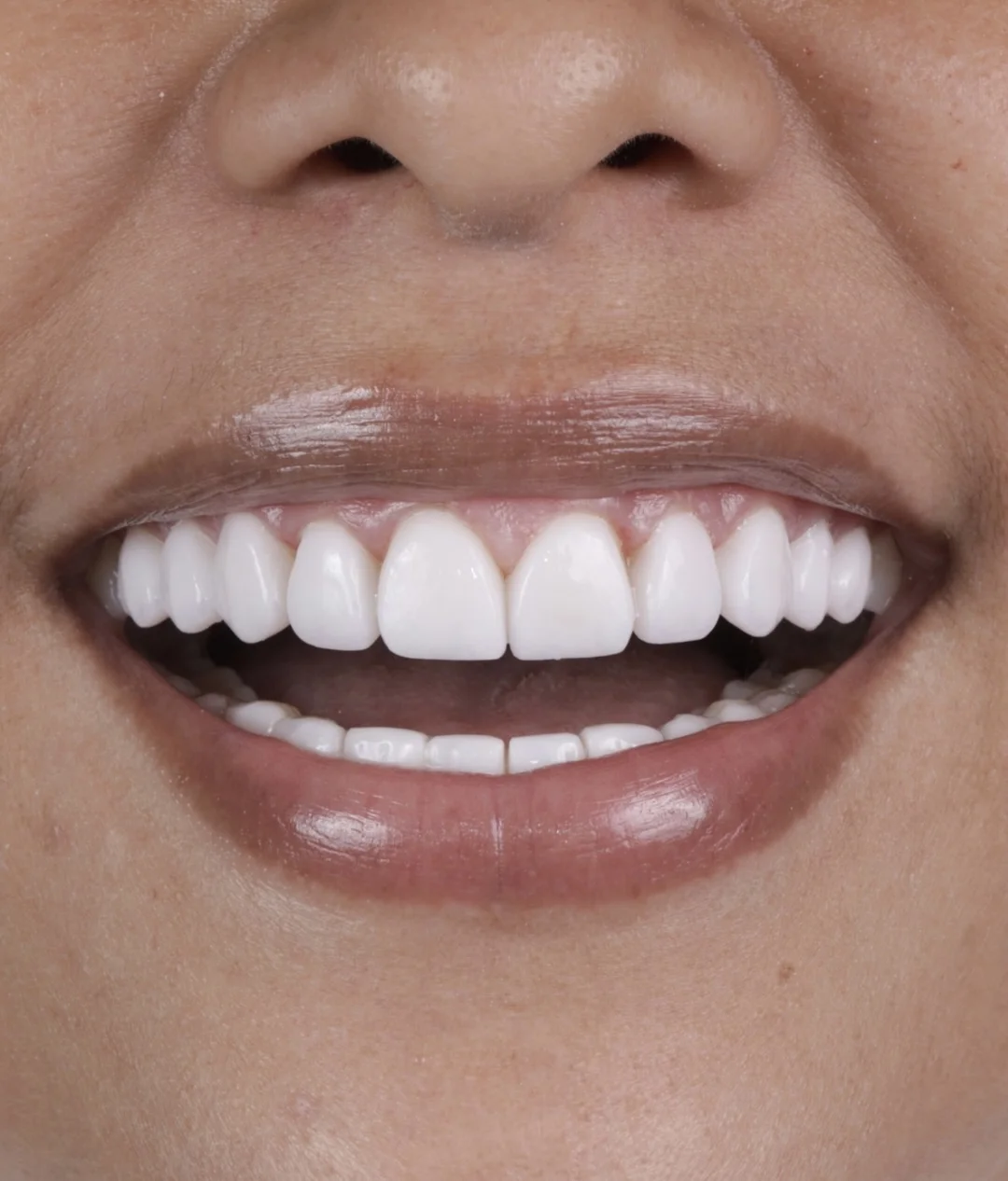 POORLY ADJUSTED VENEERS TO PORCELAIN VENEERS