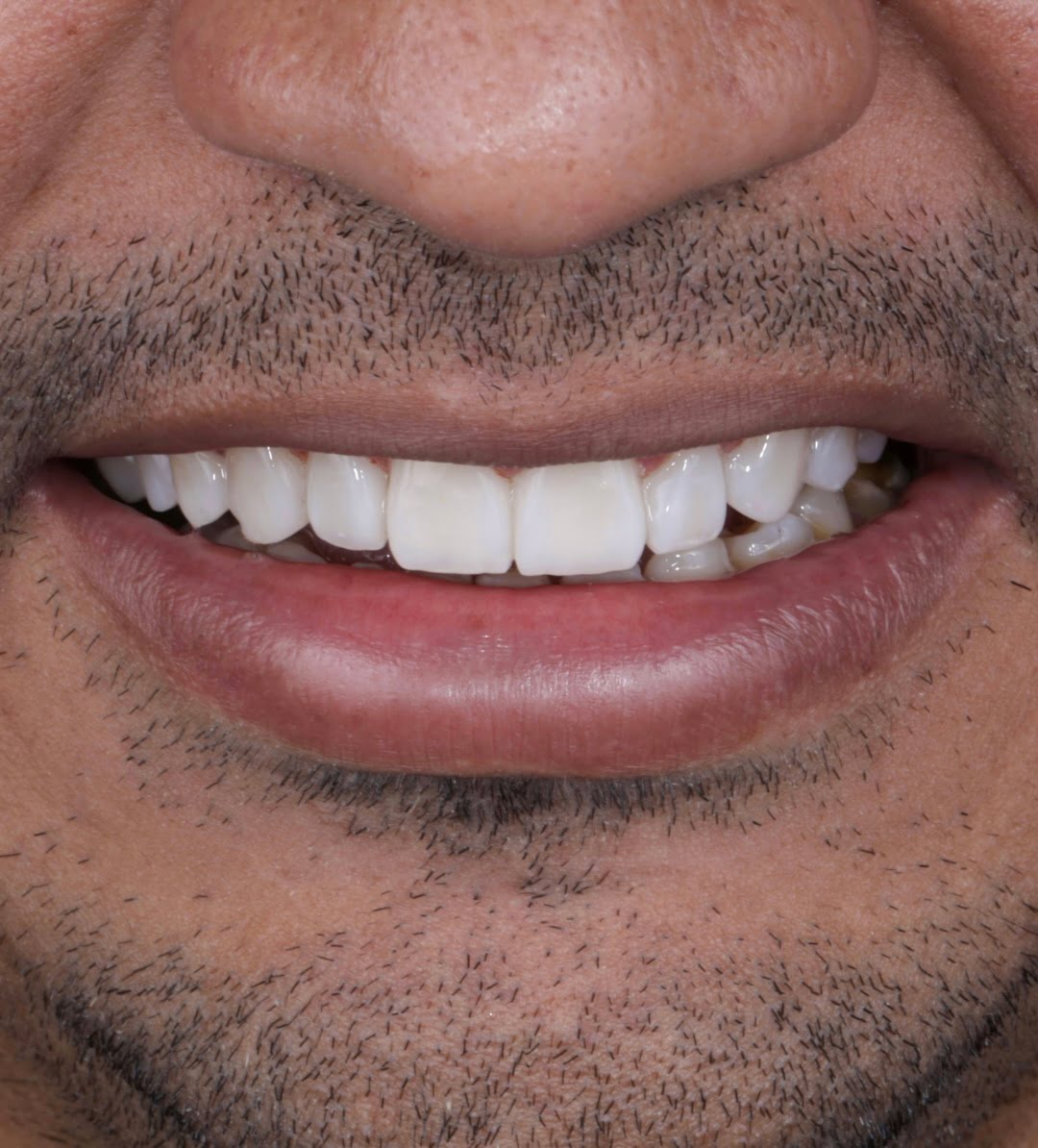 Francisco and the power of a harmonious smile: composite veneers.