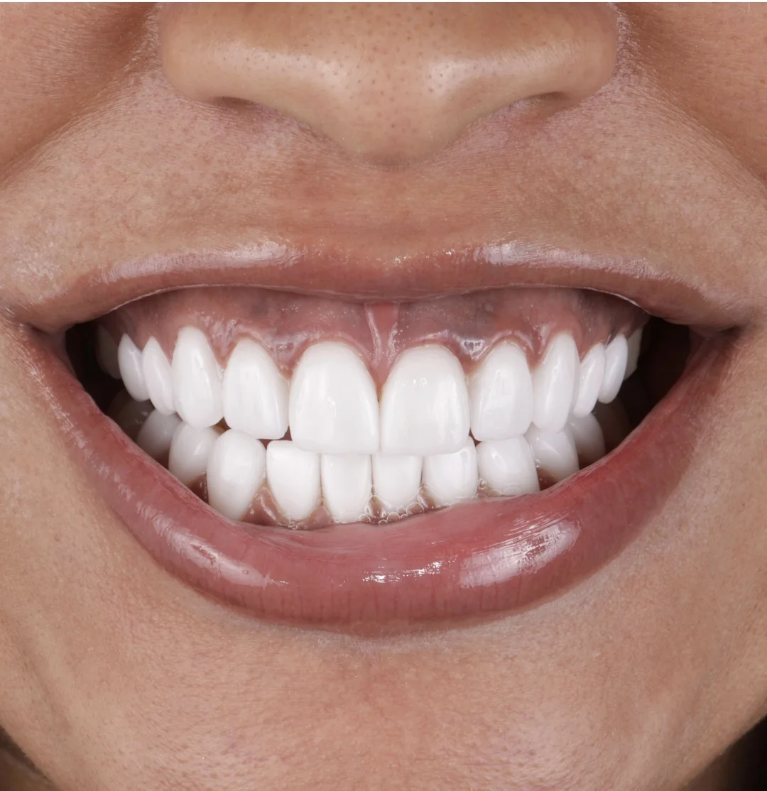 PIGMENTED TEETH TO PORCELAIN VENEERS