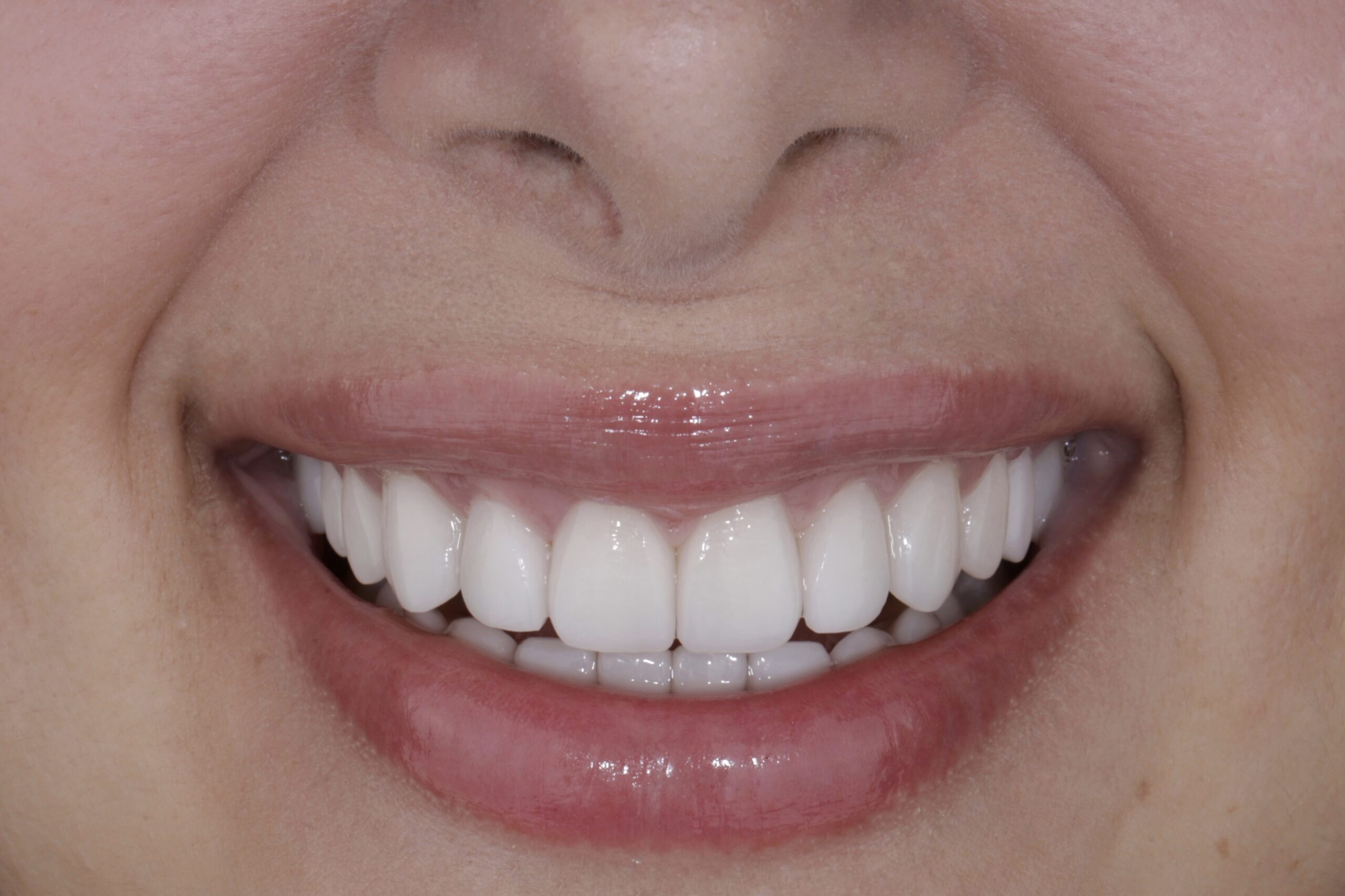 From Yellow to Radiant: Rosa’s Smile Makeover with Ceramic Veneers