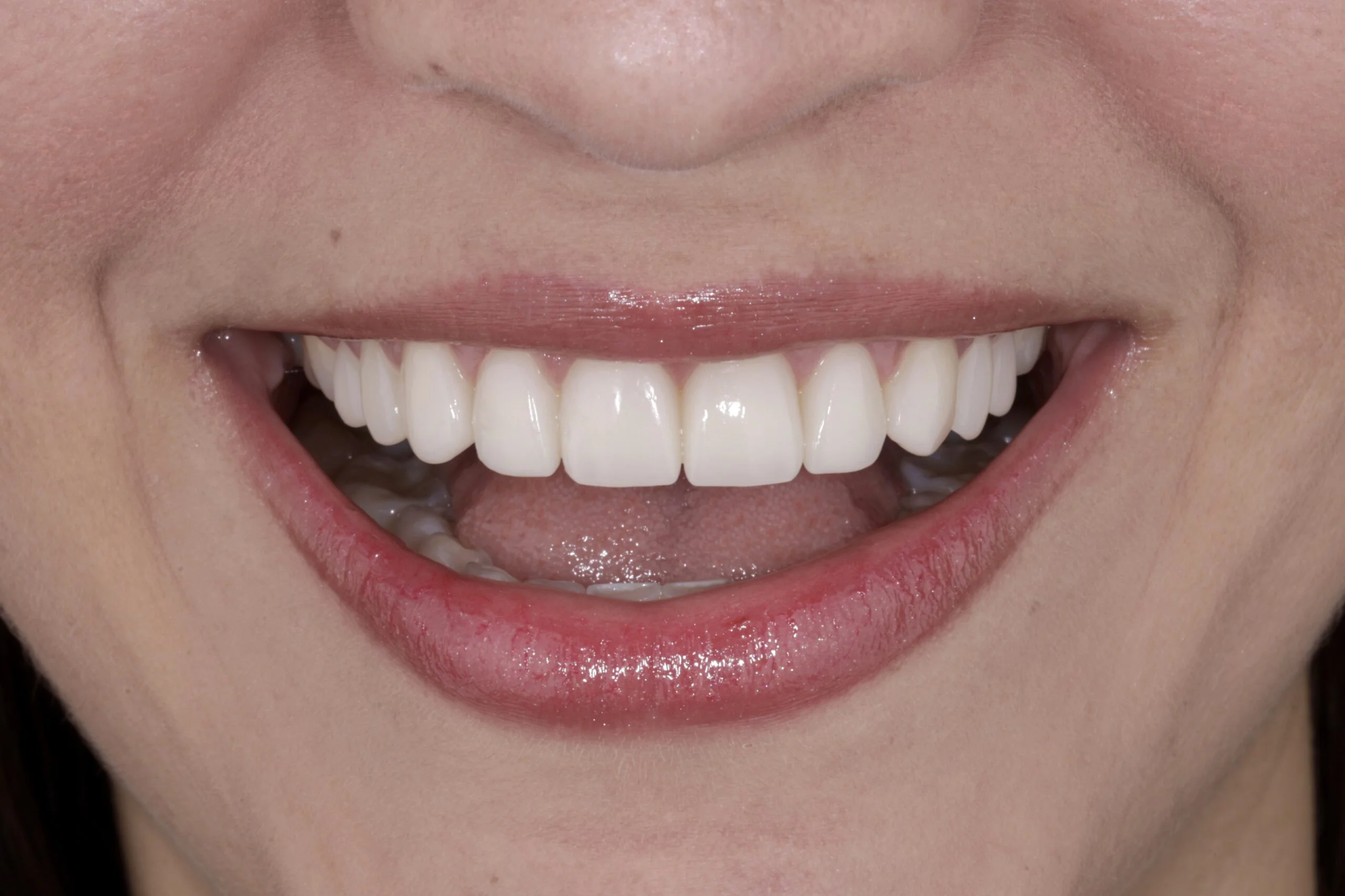 OLD VENEERS TO INDIRECT COMPOSITE VENEERS