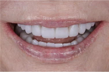 Case Review: Tooth wear and aging