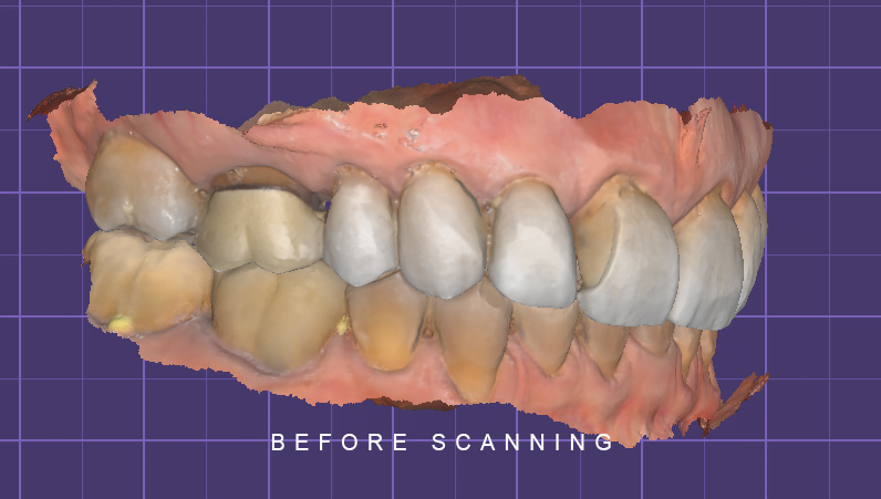 BEFORE SCANNING LATERAL EXOCAD TOOTH WEAR 1