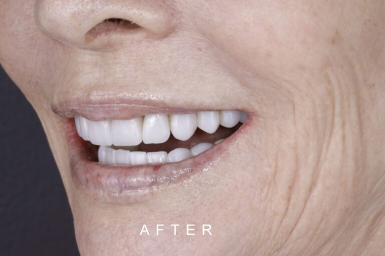 AFTER LATERAL TOOTH WEAR