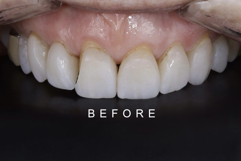 BEFORE FRONT INTRAORAL TOOTH WEAR 1