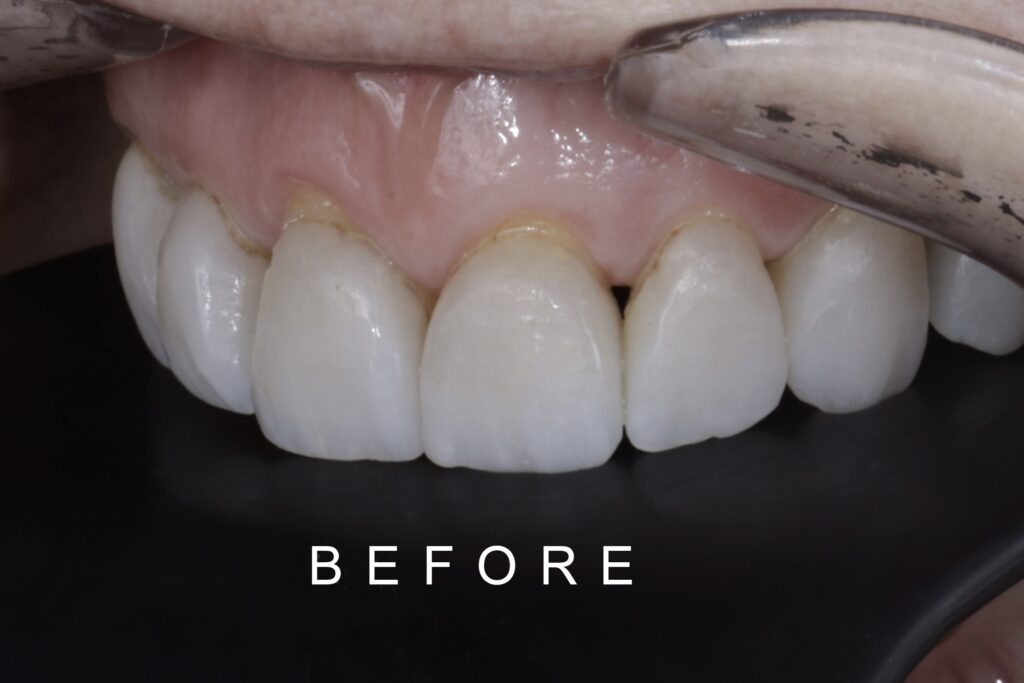 BEFORE LATERAL INTRAORAL TOOTH WEAR 2