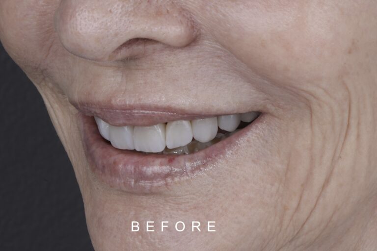 BEFORE LATERAL TOOTH WEAR