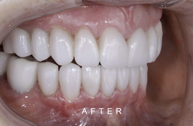 AFTER INTRAORAL FRONT TOOTH WEAR 2