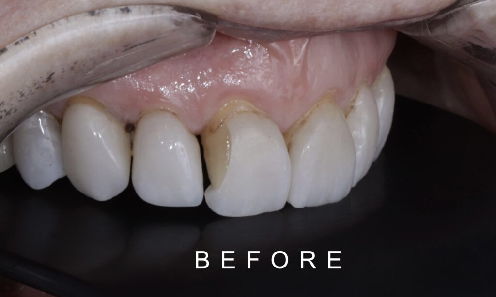 BEFORE LATERAL INTRAORAL TOOTH WEAR 1