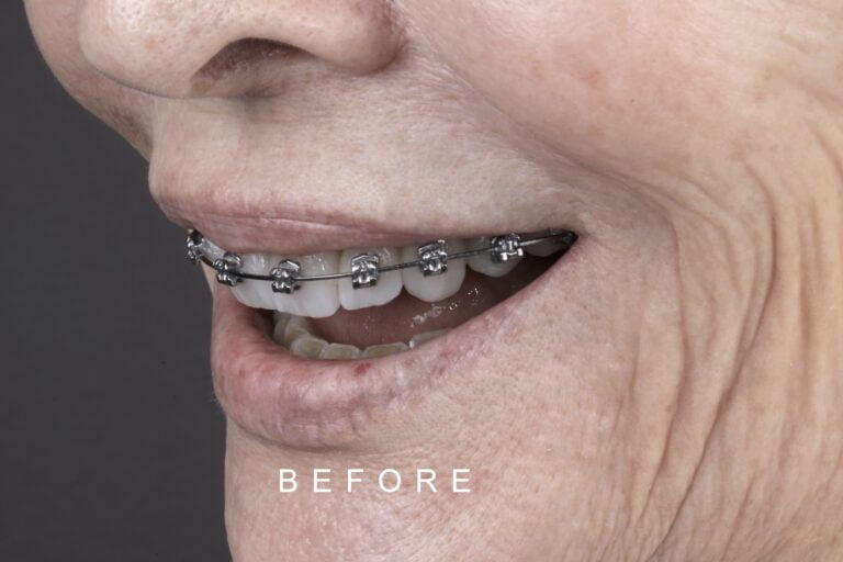 BEFORE LATERAL TOOTH WEAR