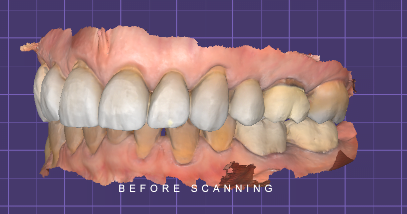 BEFORE SCANNING LATERAL EXOCAD TOOTH WEAR 2