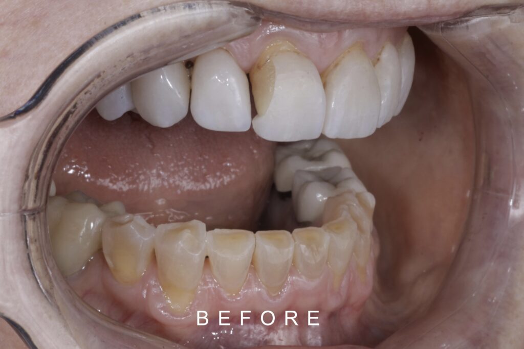 BEFORE LATERAL INTRAORAL TOOTH WEAR 3