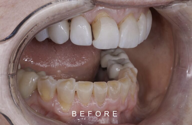 BEFORE INTRAORAL LATERAL TOOTH WEAR 2