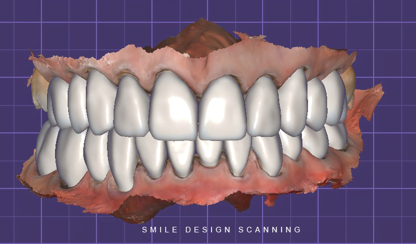 SMILE DESIGN SCANNING TOOTH WEAR