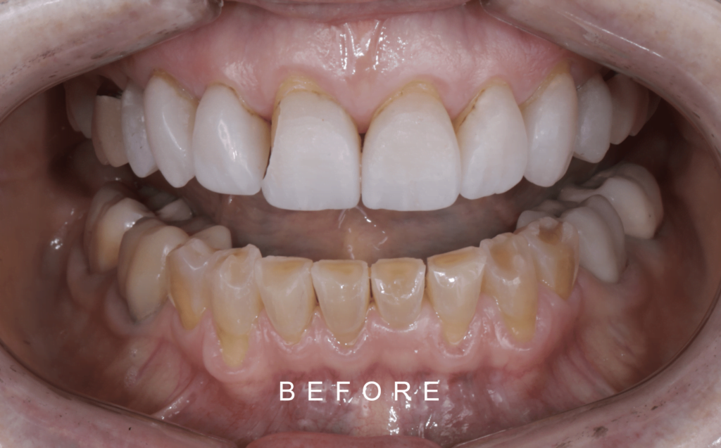 BEFORE FRONT INTRAORAL TOOTH WEAR 3