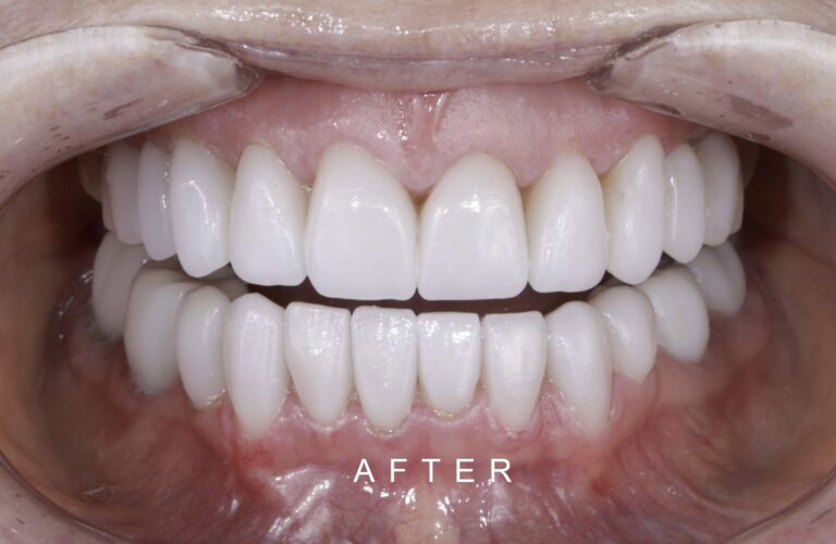 AFTER INTRAORAL FRONT TOOTH WEAR 1