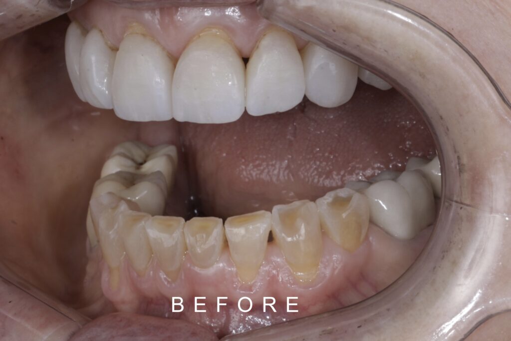 BEFORE LATERAL INTRAORAL TOOTH WEAR 4