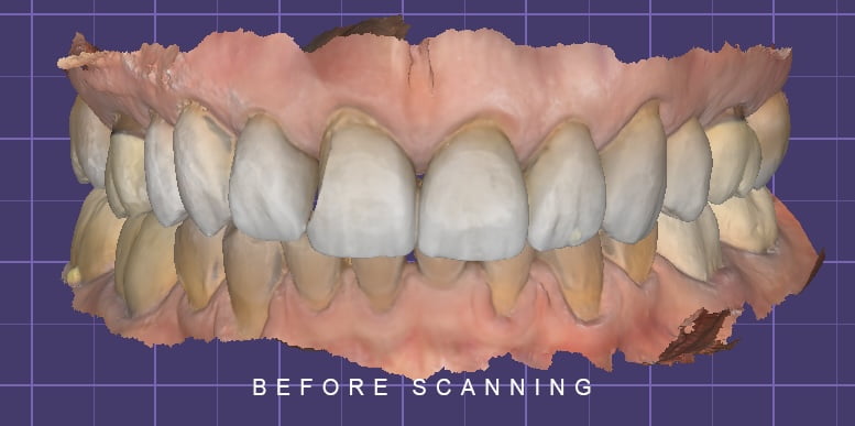 BEFORE SCANNING FRONT EXOCAD TOOTH WEAR