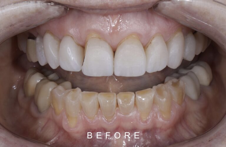 BEFORE INTRAORAL FRONT TOOTH WEAR 1