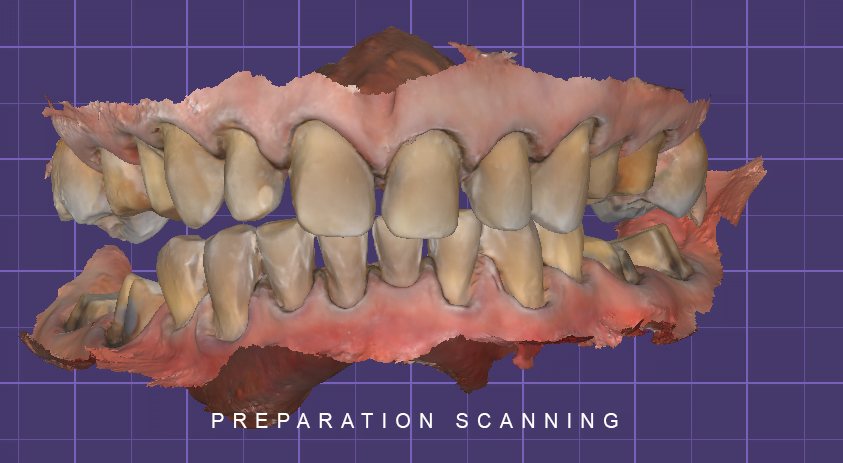 PREPARATION SCANNING EXOCAD TOOTH WEAR