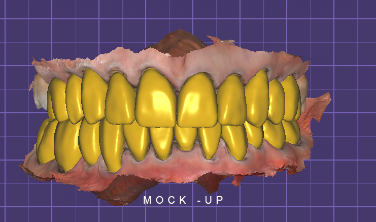 MOCK-UP EXOCAD TOOTH WEAR