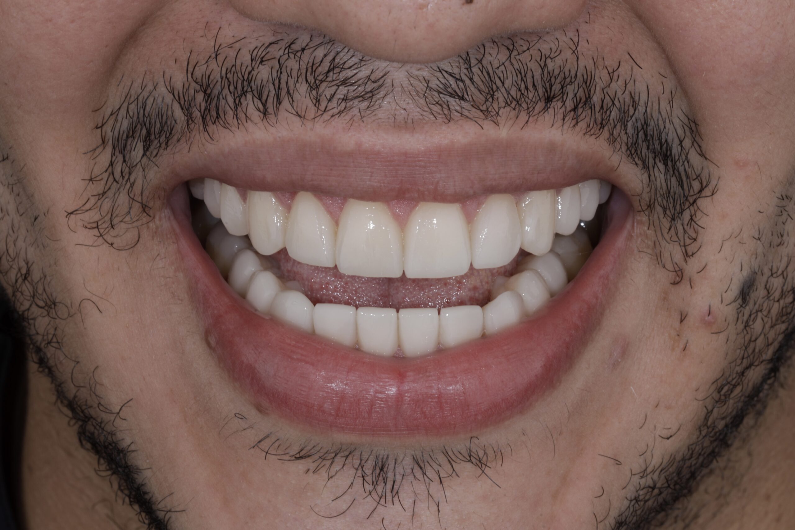 Angel´s bruxism, porcelain veneers for his smile makeover.