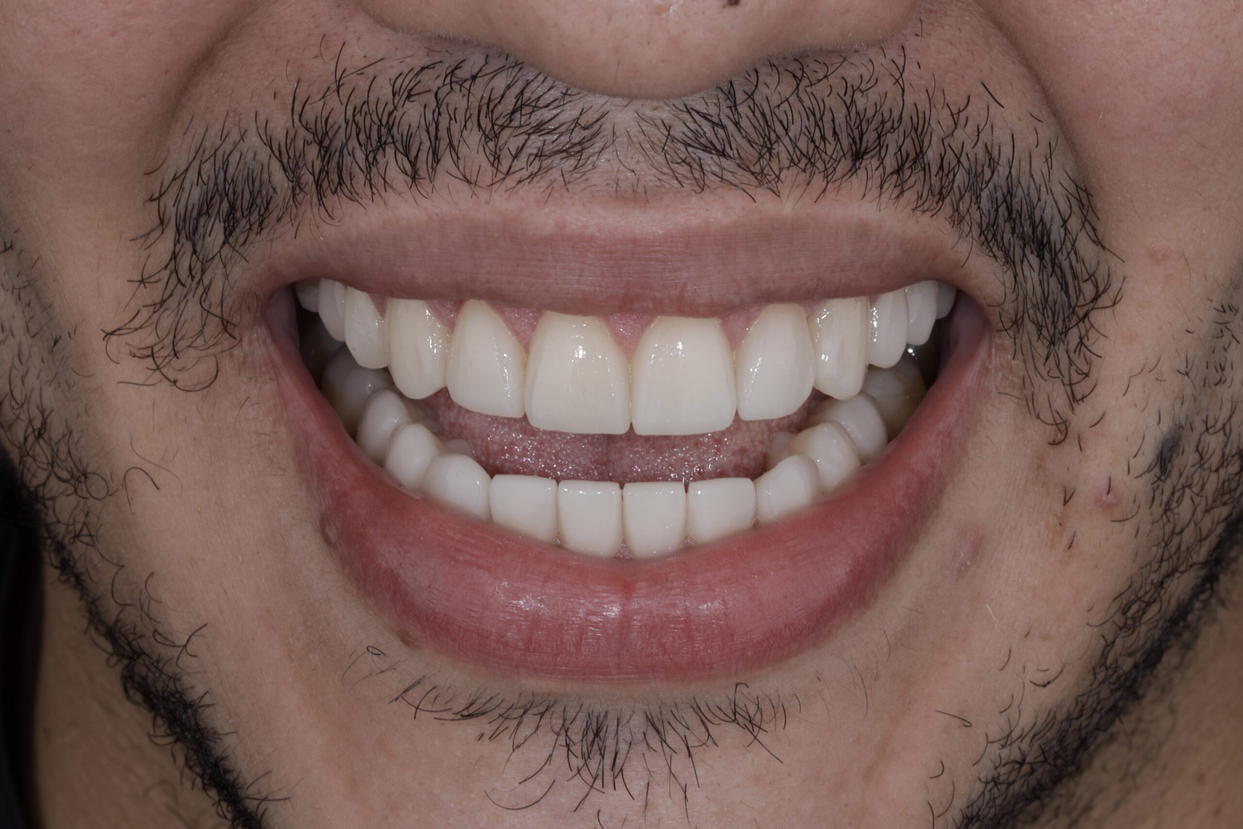 Case Review: Bruxism