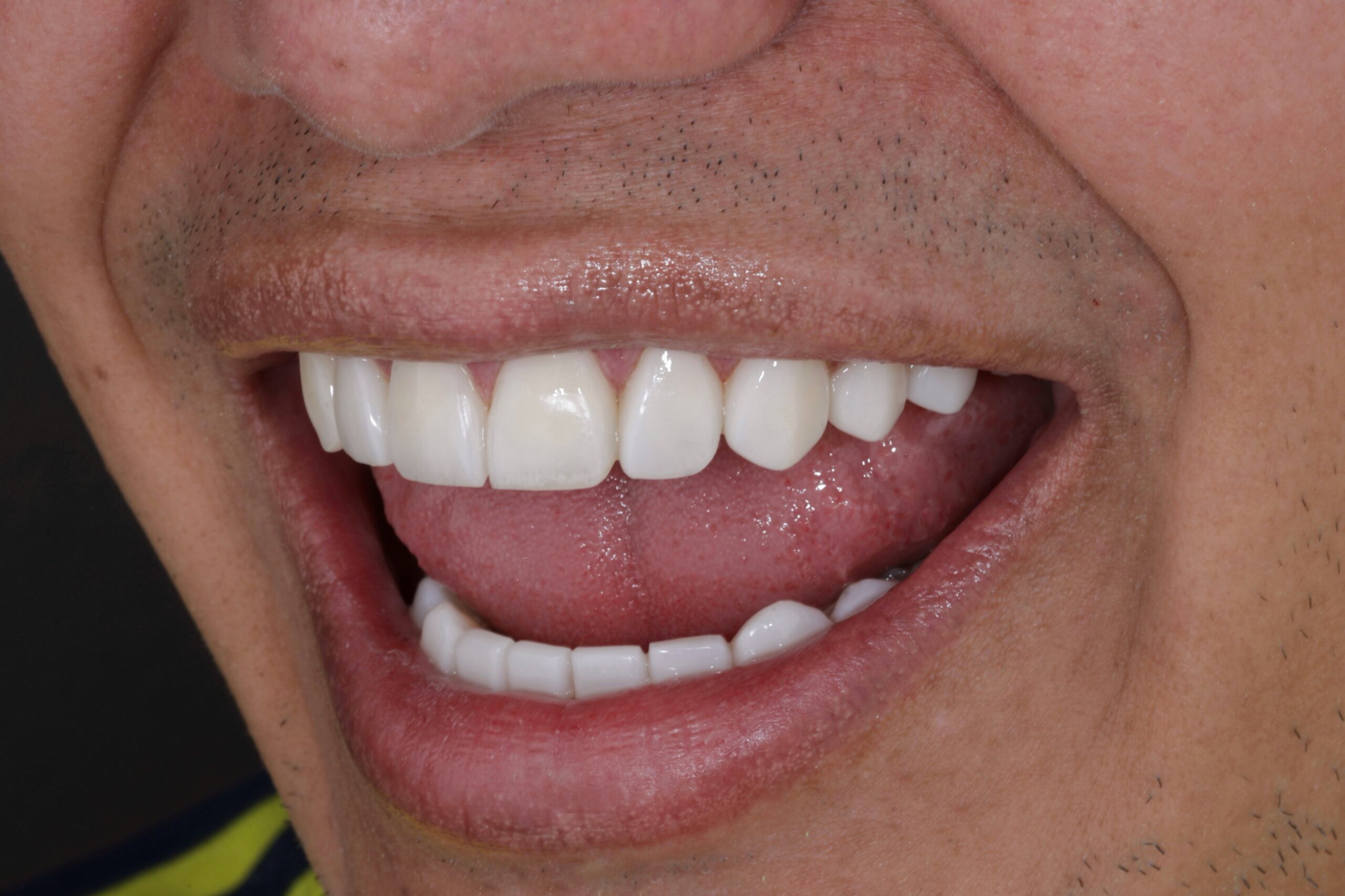 Direct composite veneers to achieve natural results.
