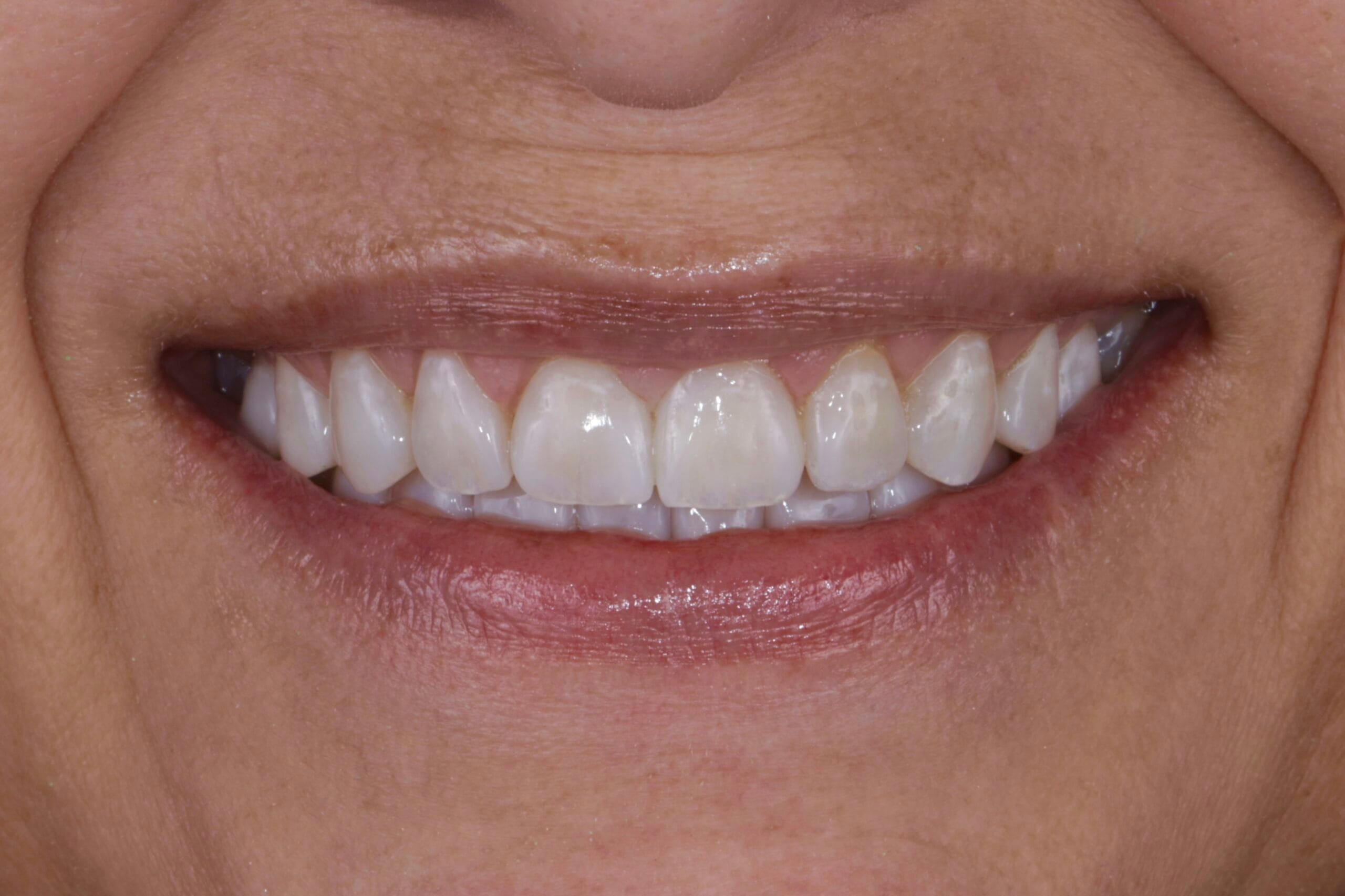 CASE REVIEW: TOOTH WEAR TO INDIRECT COMPOSITE VENEERS