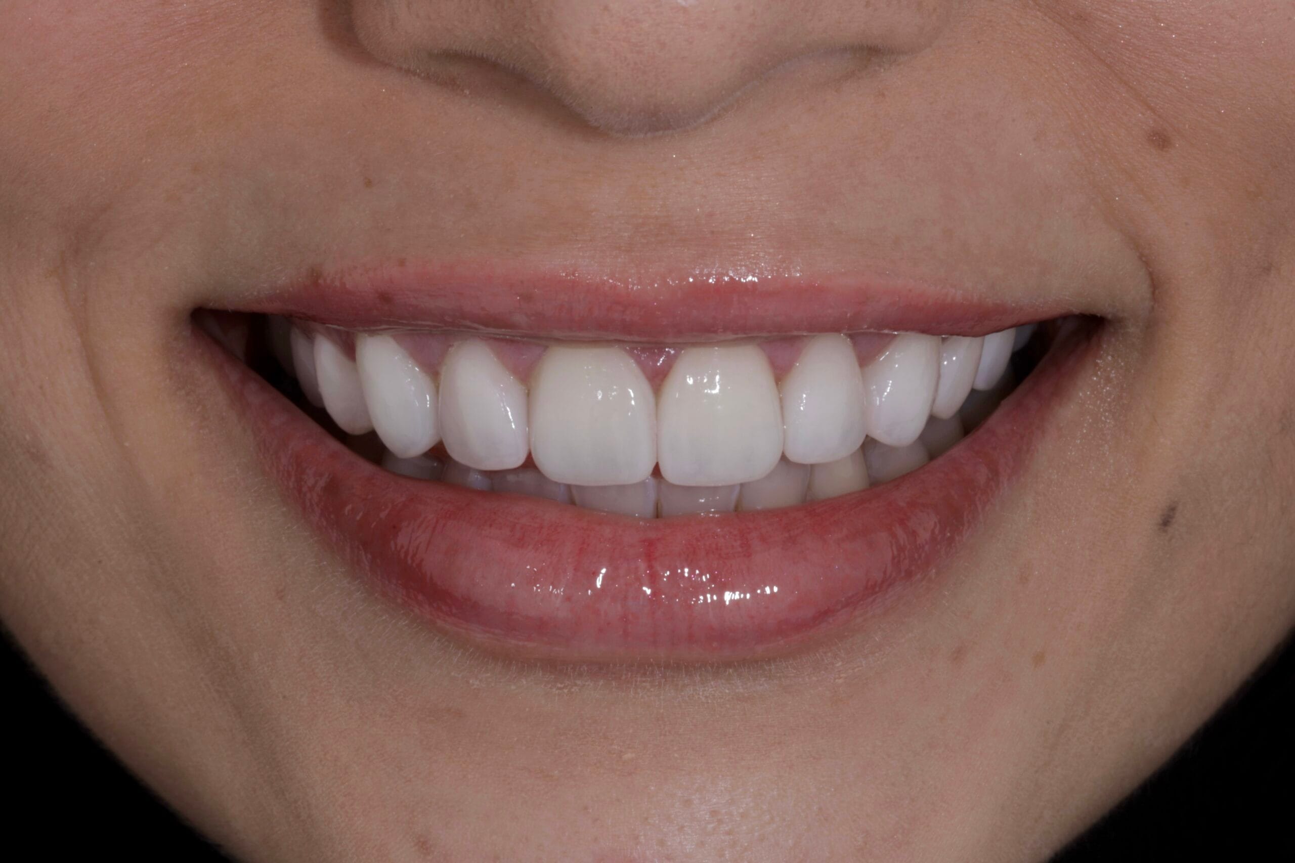 YELLOW TEETH TO PORCELAIN VENEERS