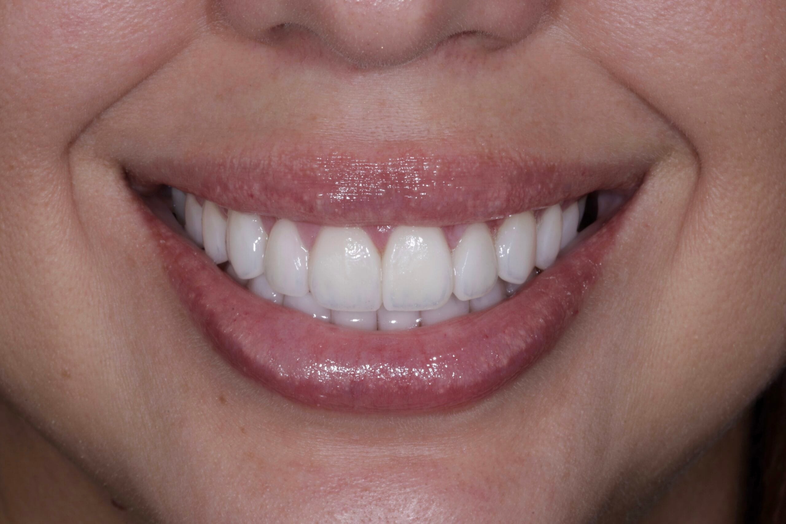 YELLOW TEETH TO PORCELAIN VENEERS