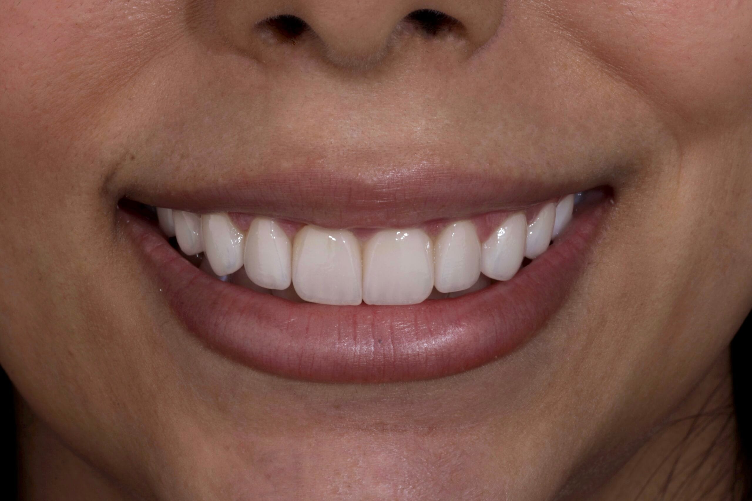 GUMMY SMILE TO PORCELAIN VENEERS