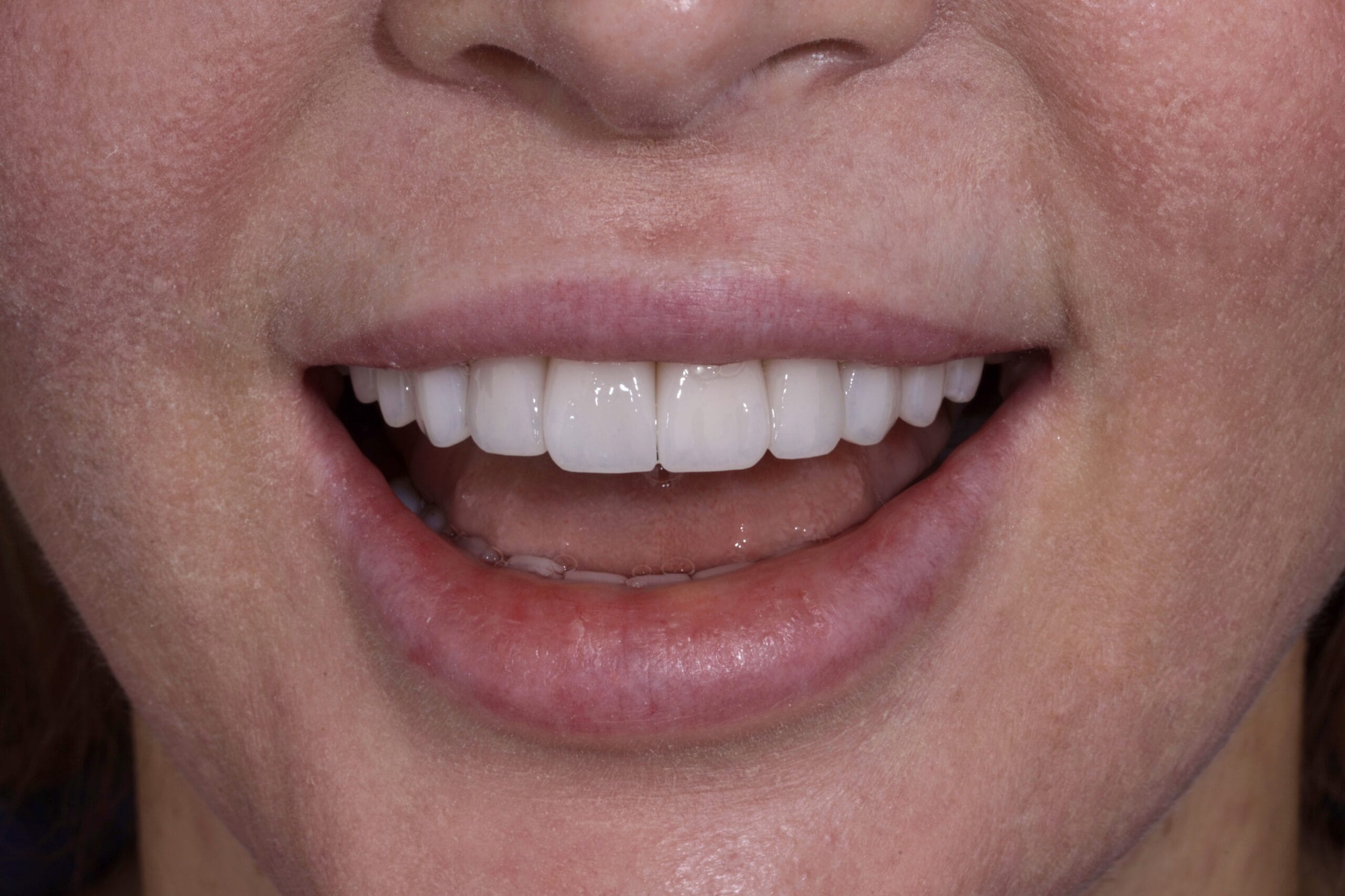 MISALIGNED TEETH TO PORCELAIN VENEERS