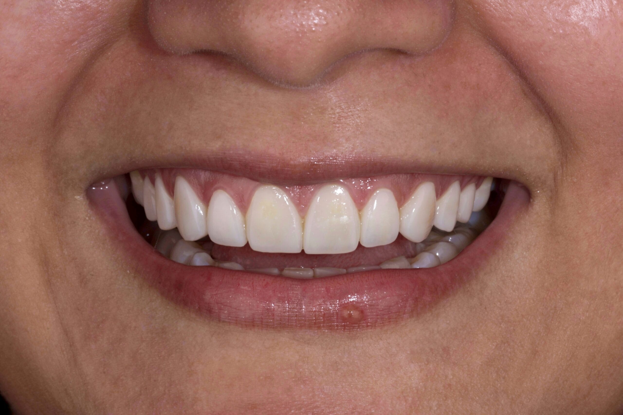 TOOTH WEAR TO DIRECT COMPOSITE VENEERS