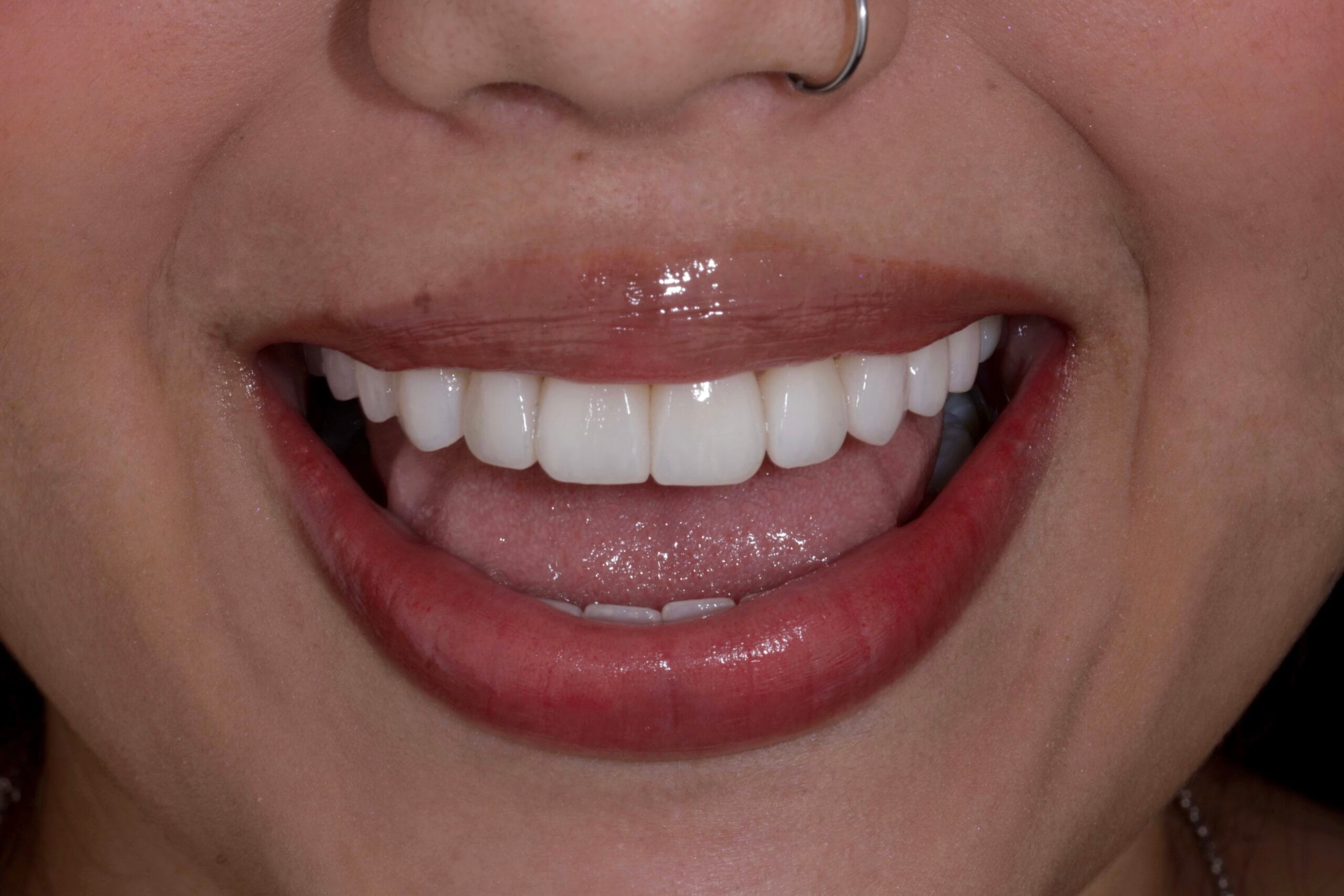 OLD COMPOSITE VENEERS TO PORCELAIN VENEERS