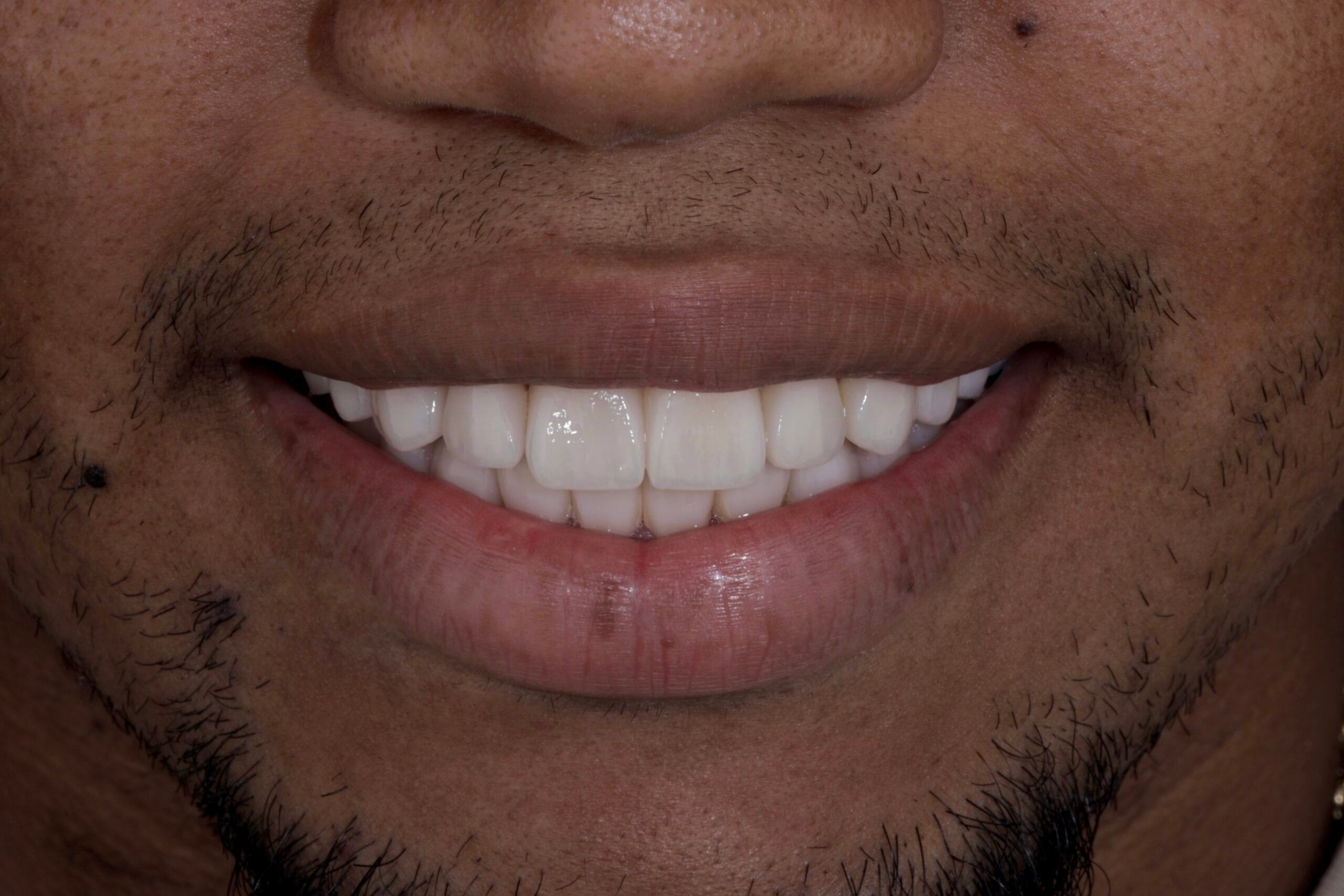 OLD VENEERS TO PORCELAIN VENEERS