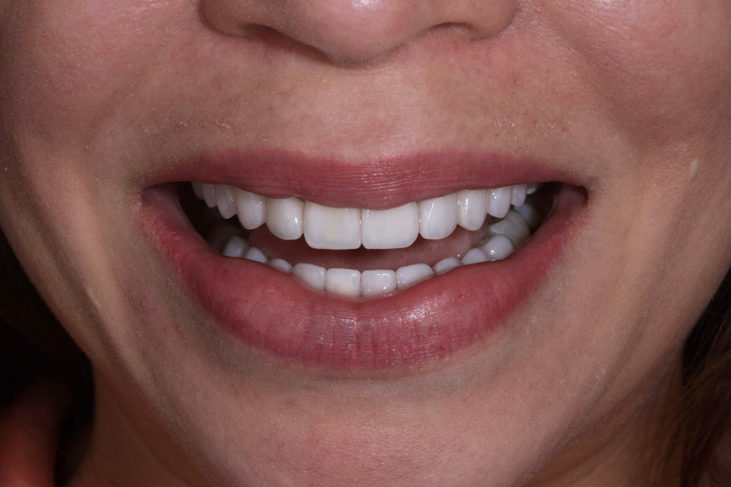 OLD COMPOSITE VENEERS TO PORCELAIN VENEERS